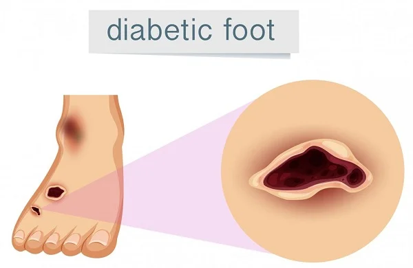 Diabetic Foot Treatment