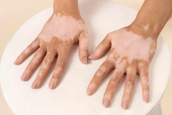 Burns Treatment